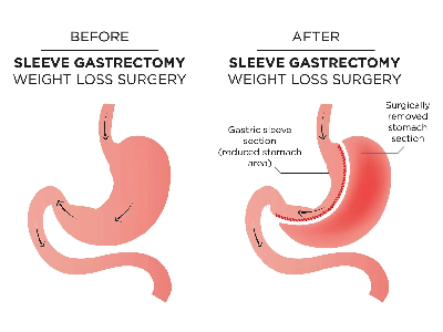 Sleeve Gastrectomy Surgery In Oceania
